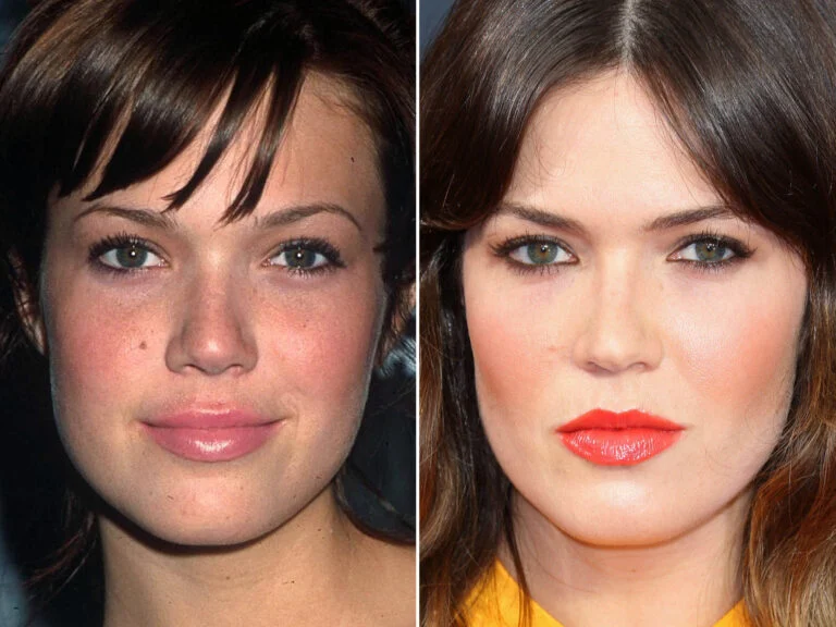 mandy moore plastic surgery