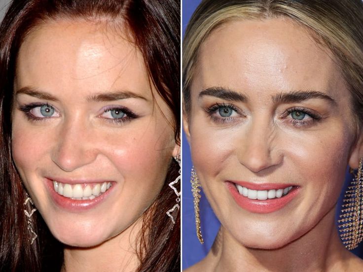 emily blunt plastic surgery emily blunt plastic surgery